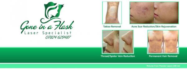 Laser tattoo removal, Laser permanent hair removal, q-switched Nd:Yag, wedding